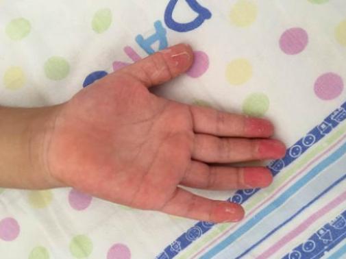 哪些国家有儿童感染新冠病毒的,现在新冠病毒儿童最新症状