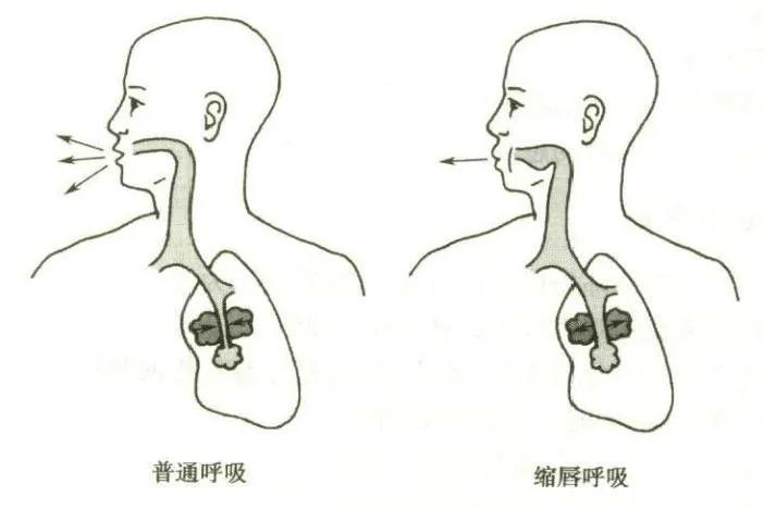 慢阻肺不咳了还是呼吸困难怎么办,慢阻肺不咳了可以停止吸药吗