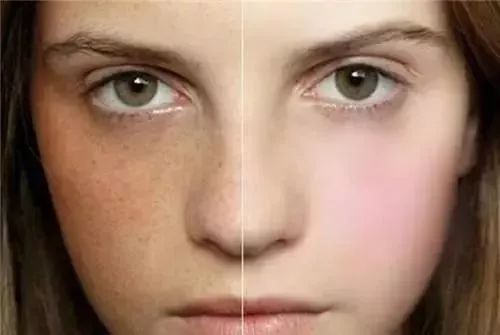 鼻子长痘是肝火还是胃火,鼻子长斑是代表什么部位有癌症