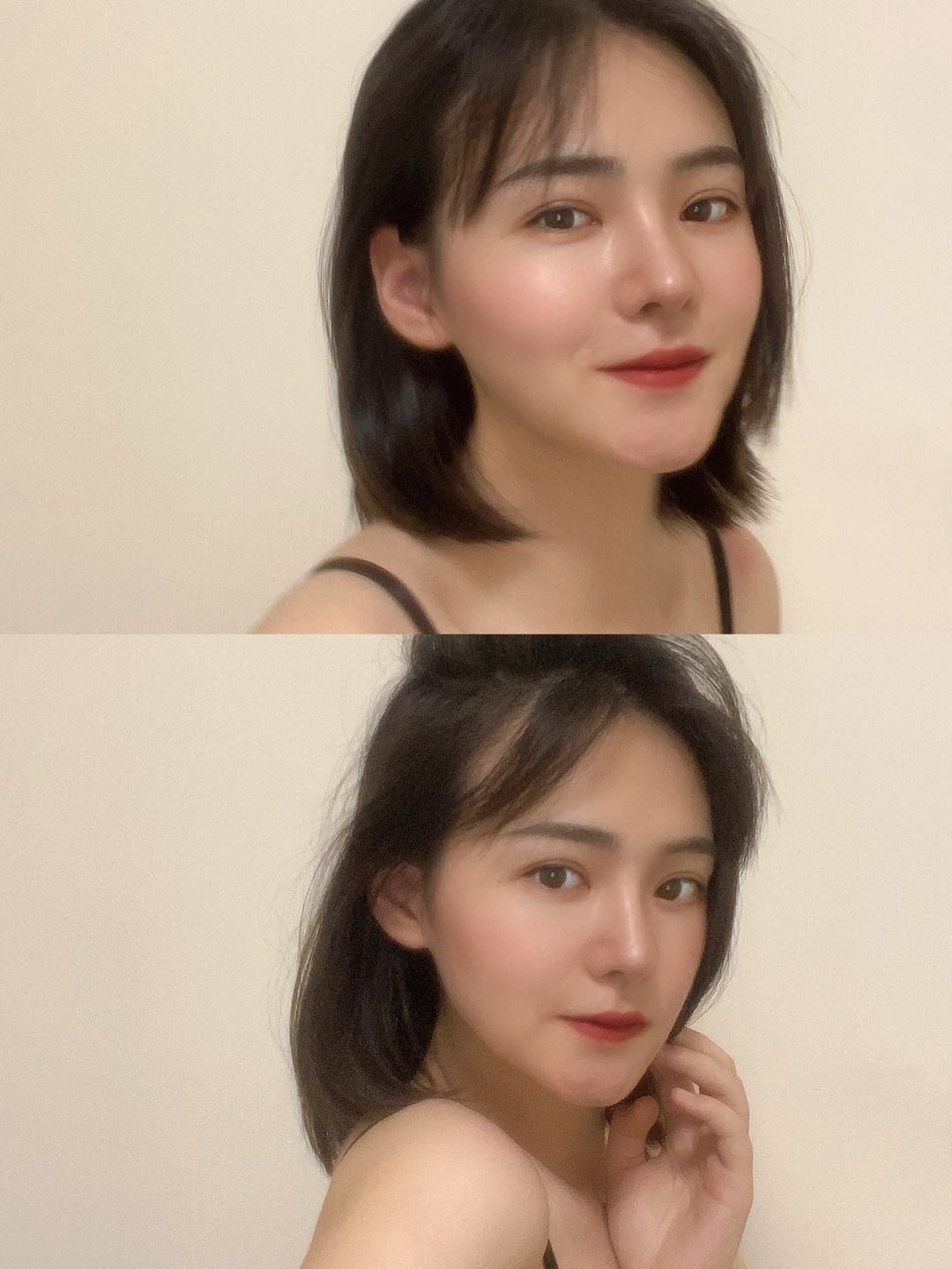 嘴凸鼻基底凹陷法令纹练背有用吗,鼻基底凹陷填充后对法令纹有改善