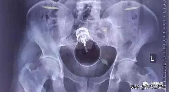 医院取出的异物怎么处理,医生都从患者体内取出过什么异物