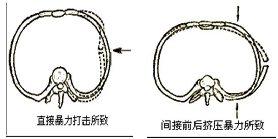 健康科普正确认识骨折才能好得快,正确认识尾椎骨疼痛