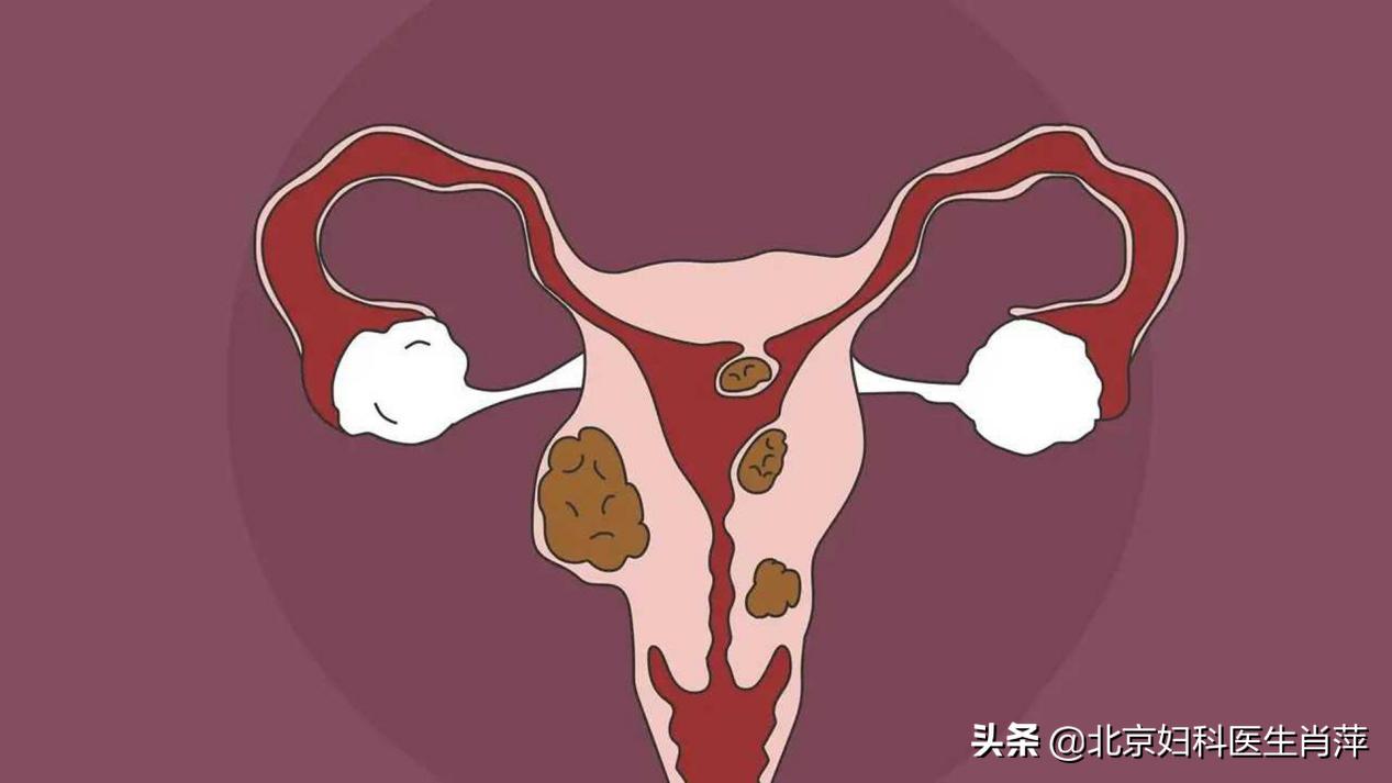 南京看子宫腺肌症哪家好,子宫腺肌症广安门医院