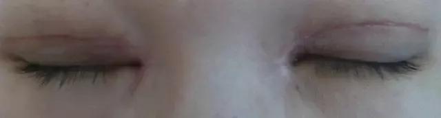 双眼皮修复为什么更贵,双眼皮修复是怎么做的