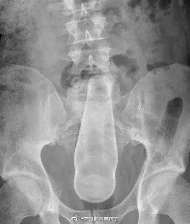 菊花塞足球，人体的极限到底有多大？