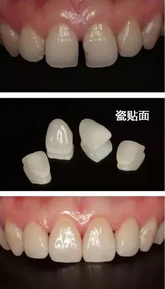 牙缝太细了能不能补一下,很小的牙缝可以补吗