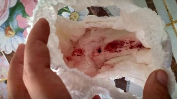 女子在河边泡脚被水蛭咬,被水蛭咬血流不止