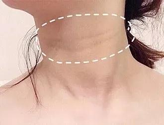 25岁就有颈纹了是怎么回事,30岁脖子颈纹好深怎么办