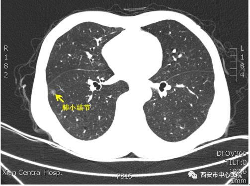肺上长结节怎么治疗,肺上长痘痘是怎么回事
