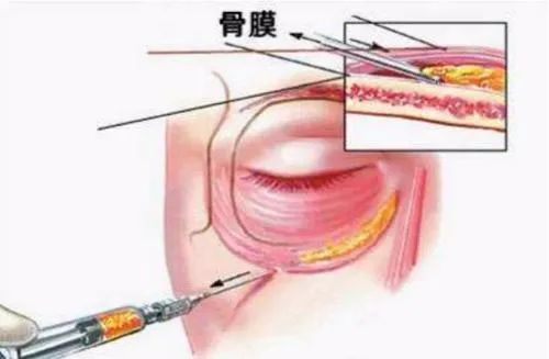 轻医美干细胞填充泪沟真实案例,泪沟明显怎么做医美