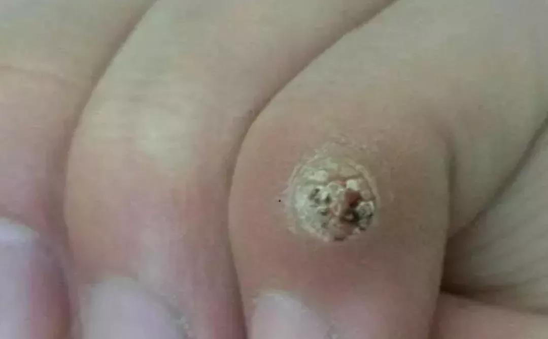 脸上长了像黑痣一样的东西,脸上长了像痘痘的东西是啥