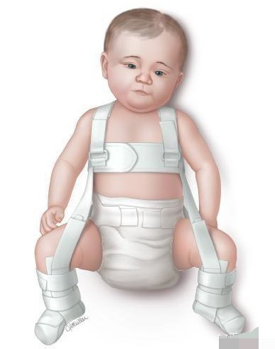 髋关节发育不对称怎么办,腿纹不对称髋关节发育不良