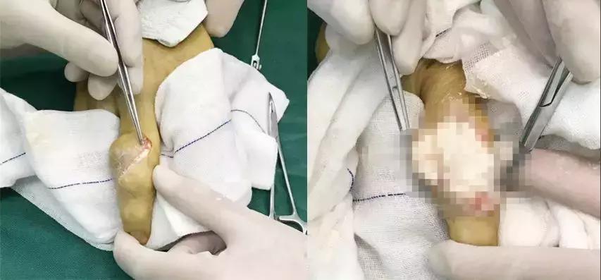 痛风脚踝有痛风石怎样才能变小,痛风石是引起痛风的根本原因吗