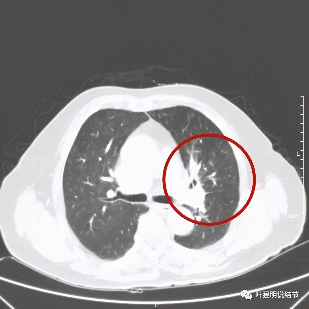 卡瑞利珠单抗治疗肺鳞癌有用吗,特瑞普利单抗对鳞癌治疗有效吗