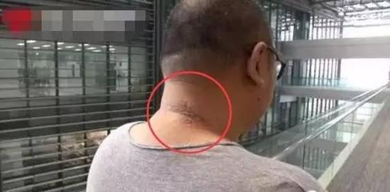 隐翅虫咬人后早期图片及症状,隐翅虫咬人后图片和症状