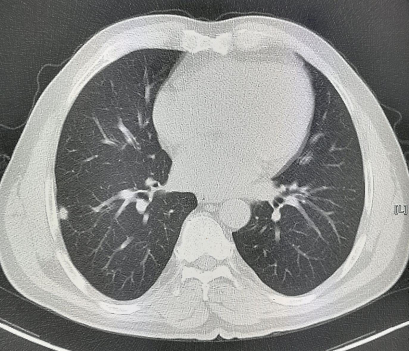 5个小故事：肺结核、脑梗死、车祸，这些意外发现的肺癌都能治
