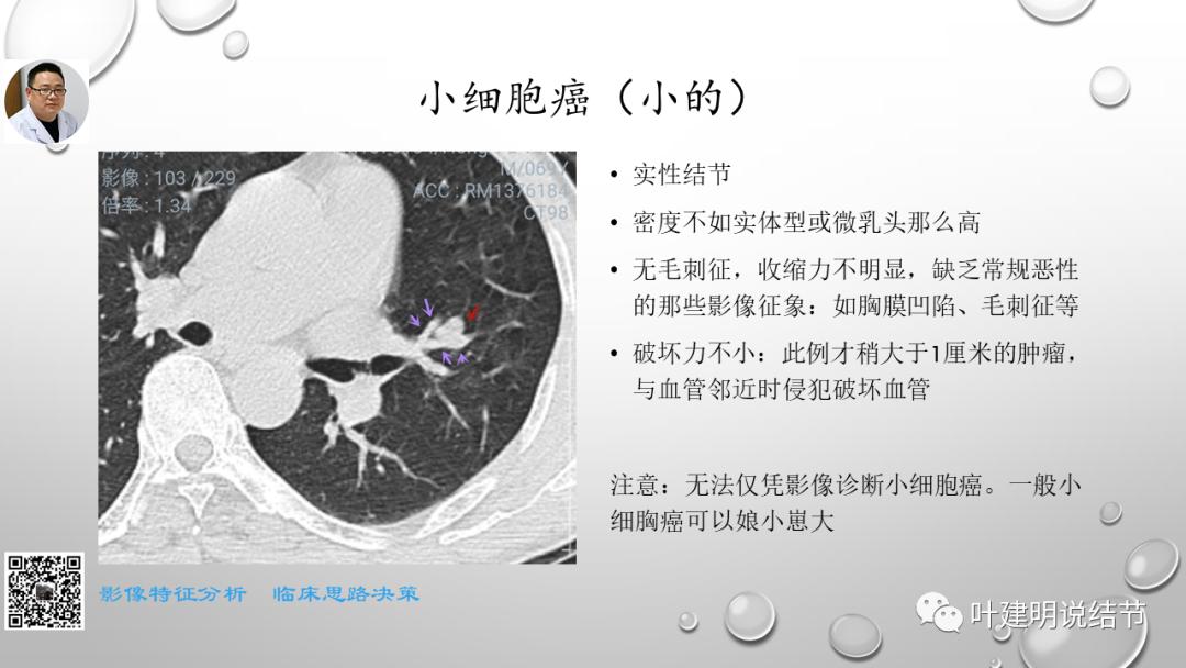 叶建明谈肺实性小结节视频,廖正银教授谈肺结节