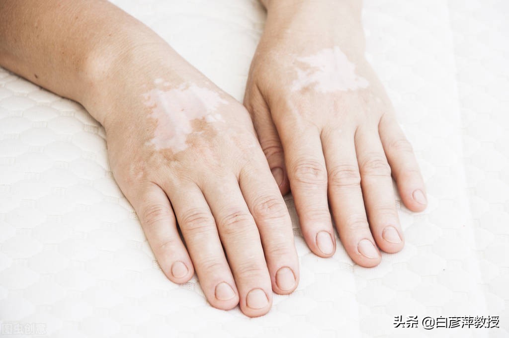 怎么才能辨别自己是否得了白癜风,皮肤科专家揭秘白癜风的发病原因