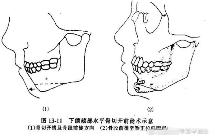 正畸矫正骨性难还是牙性难,正畸和正颌