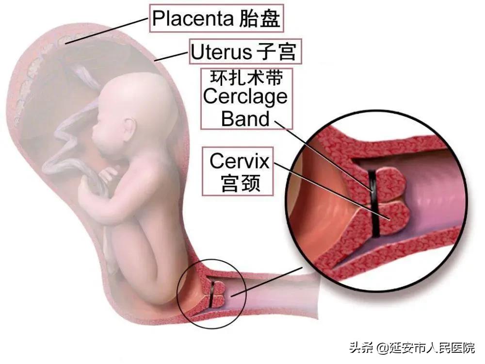 宫颈机能不全患者的福音丨宫颈环扎术