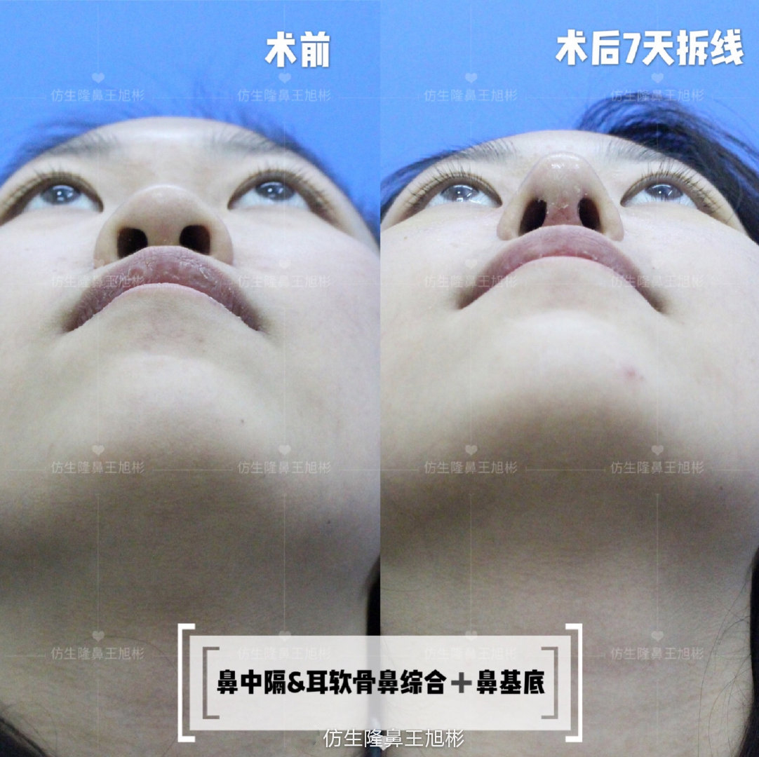 缩鼻翼可以改善鼻翼下垂吗,鼻翼肥大之鼻翼缩小术你见过吗
