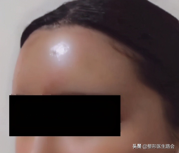 玻尿酸填充额头头部肿胀,玻尿酸填充额头之后很痛