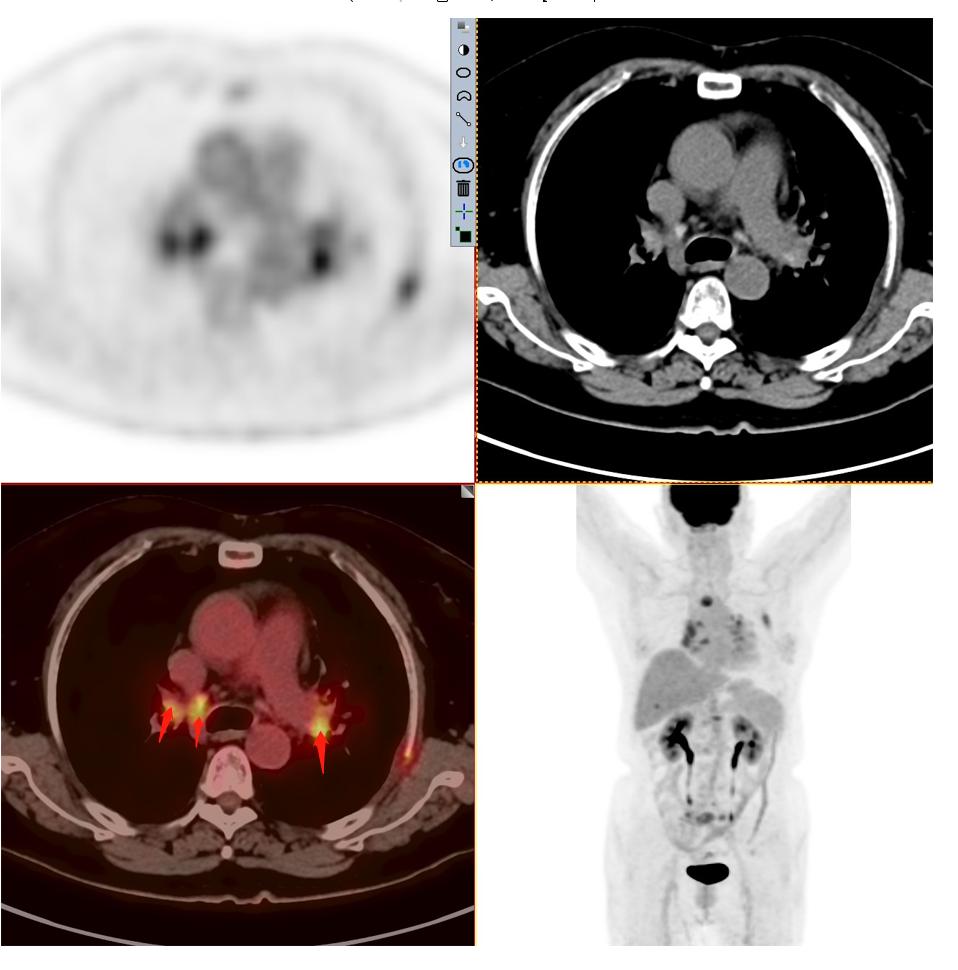 肺结节检查是薄层ct还是三维重建,肺结节检查用什么ct