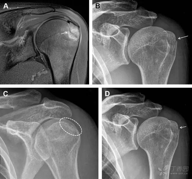 常见的八种骨折,容易漏诊的肩关节骨折