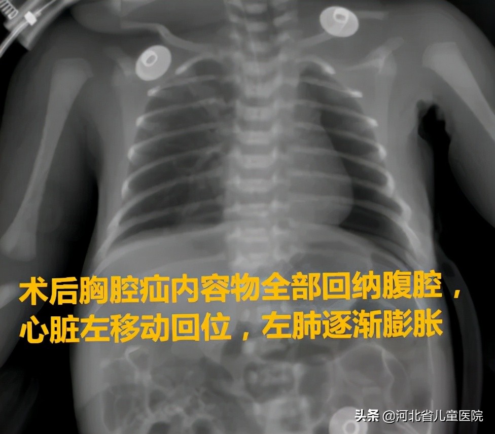 先天性膈疝孩子能活多久,先天性膈疝治疗后续