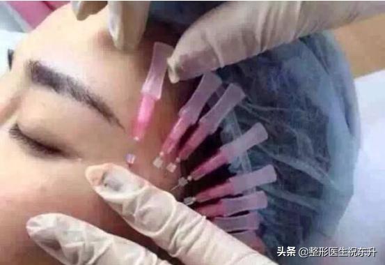 埋过线还能做拉皮吗,面部埋线提升颧骨变得很高怎么办