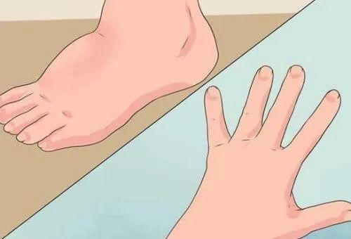 肾脏引起的手指肿胀应该怎么办,肾脏衰竭的早期症状手指肿胀