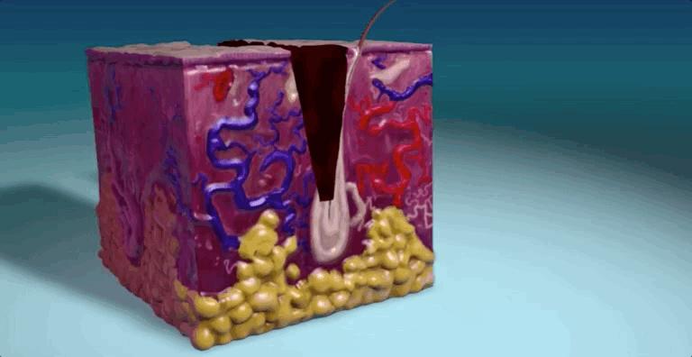 怎么恢复愈合伤口留下的疤痕,科普短片伤口是如何愈合的