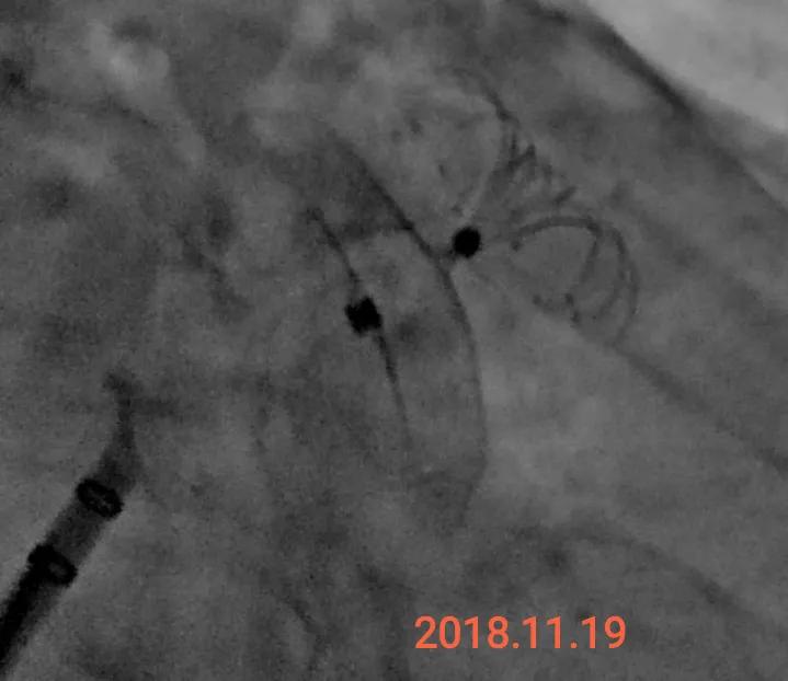 心血管病人吃伟哥,心血管病人可以用伟哥吗