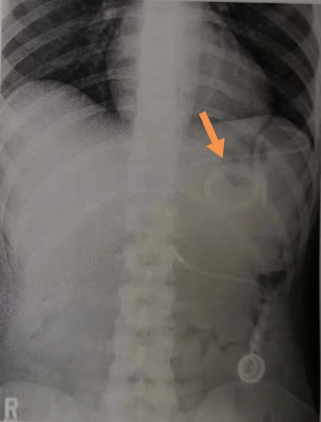 辟谣：每餐少吃点，胃就会缩小？医生说：缩胃手术减肥要谨慎