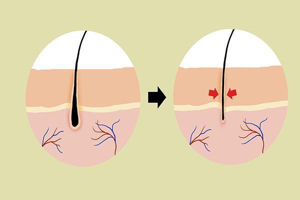 脂溢性脱发解决头皮出油方法,头发爱出油头皮有小红疙瘩脱发