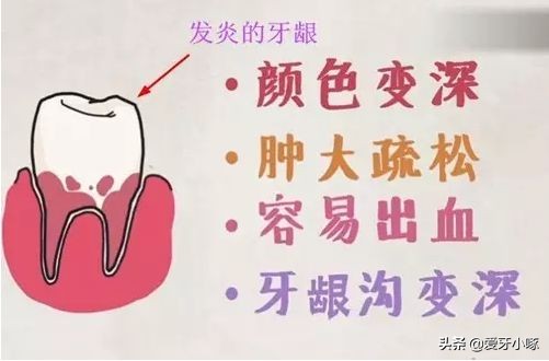 牙齿吃冷热东西疼痛怎么治疗,吃东西牙齿又酸又疼是什么原因