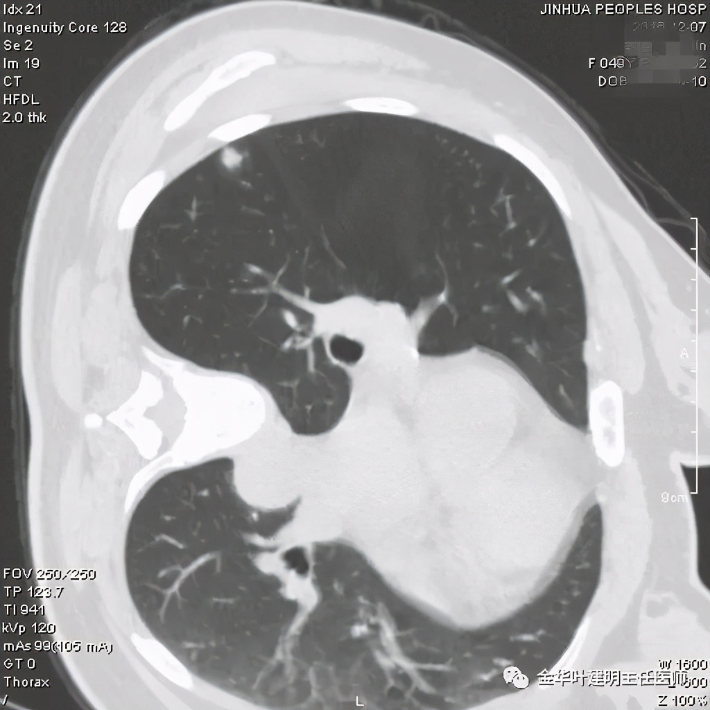 叶建明谈肺结节:一招分辨隐球菌性肉芽肿与肺癌