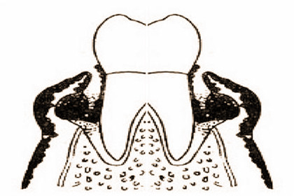 牙痛怎么缓解有妙招,牙痛怎么快速解决小妙招