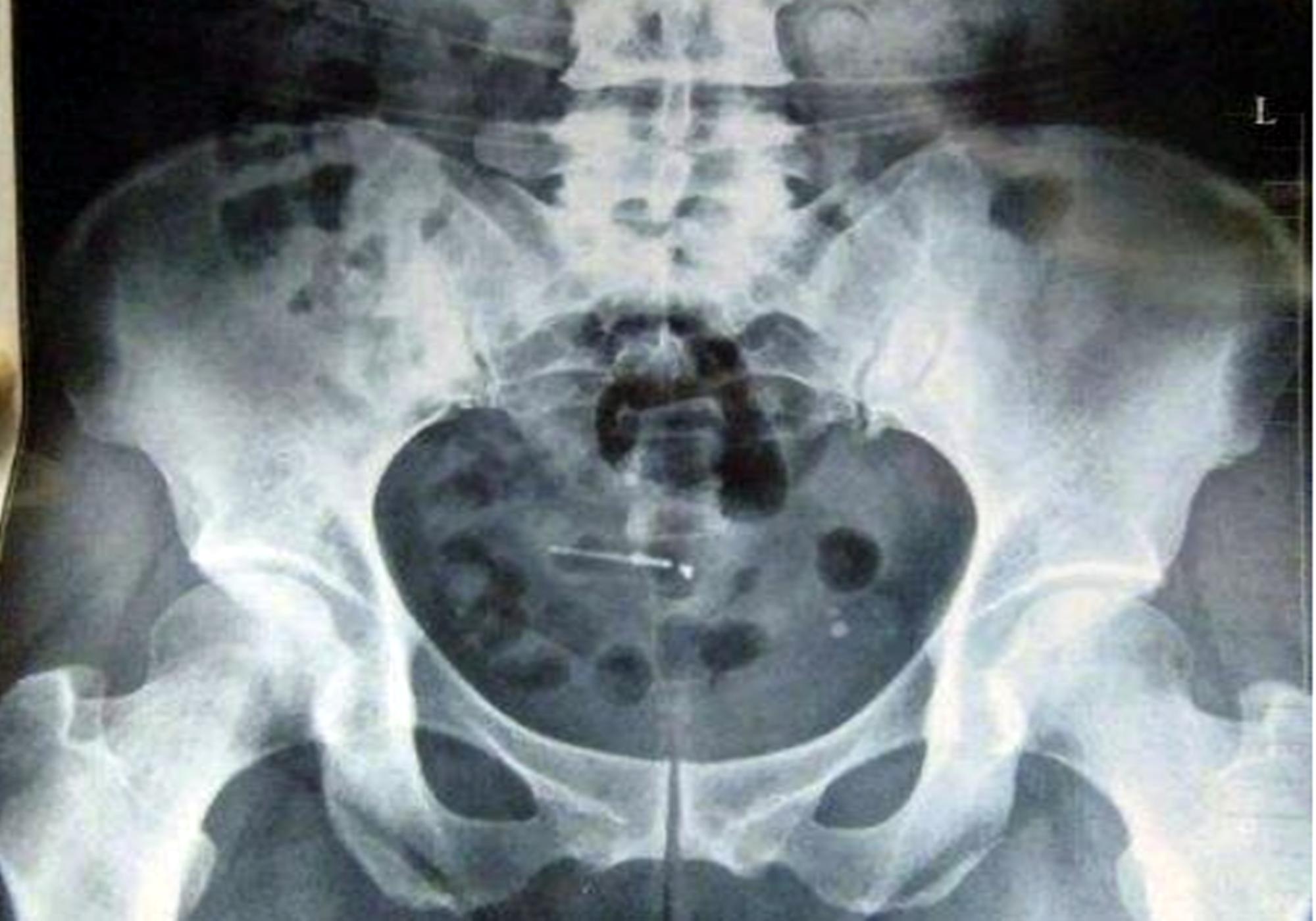 上环妈妈取环,几十年前女性上环