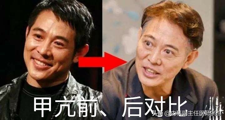 甲亢——轻松就能治好的慢病，李连杰等人却深受其害！