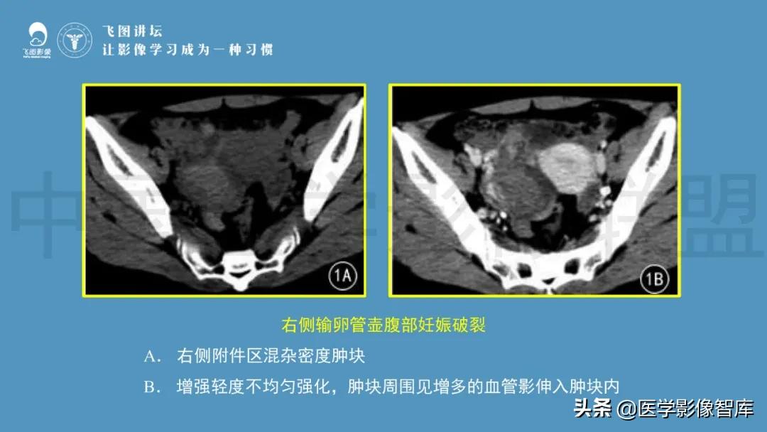 子宫解剖结构输卵管和卵巢位置,子宫附件ct影像学正常解剖表现