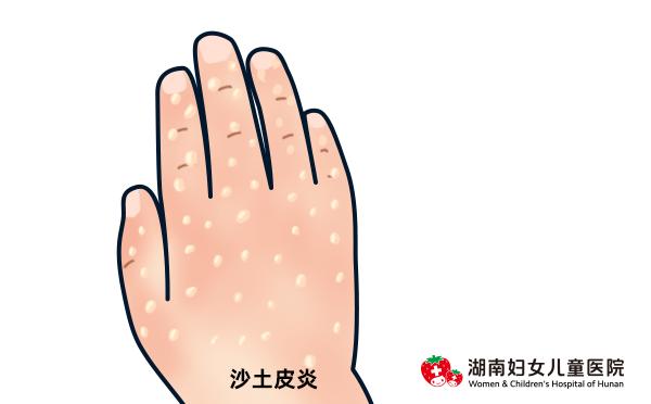 小孩夏天怎么防止痒疹,夏天的宝宝怎么避免热疹