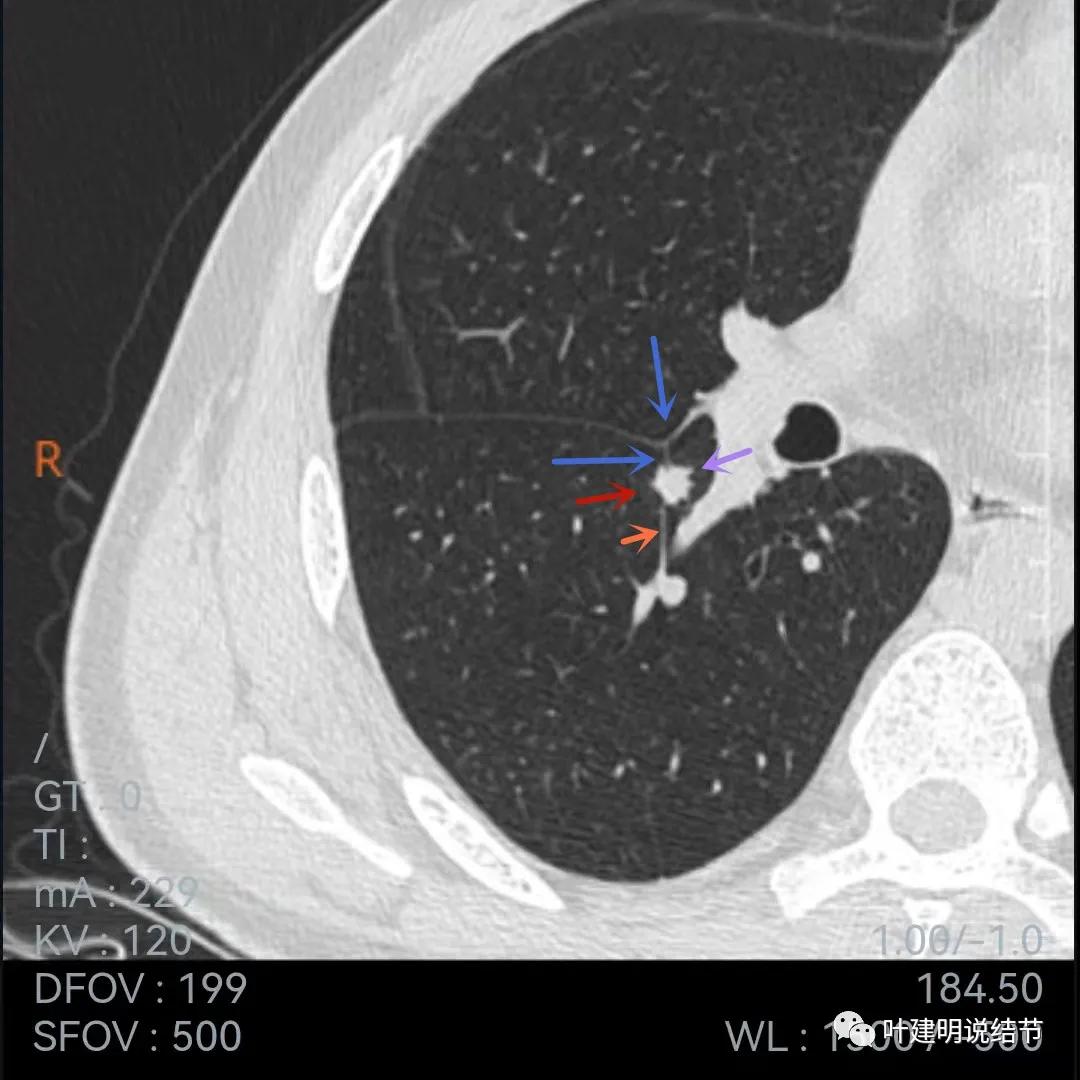 问诊分析：存在了4年的实性结节会不会是肺癌？