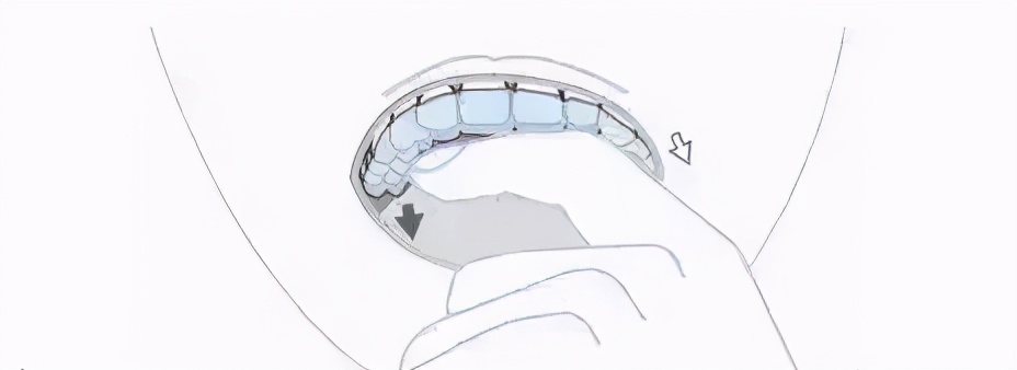 戴隐形牙套如何100分护理？