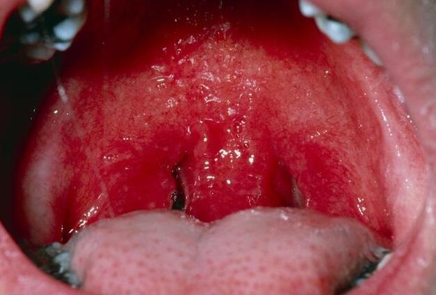 慢性咽炎为什么反复感冒,慢性咽喉炎可以用急性咽炎药吗