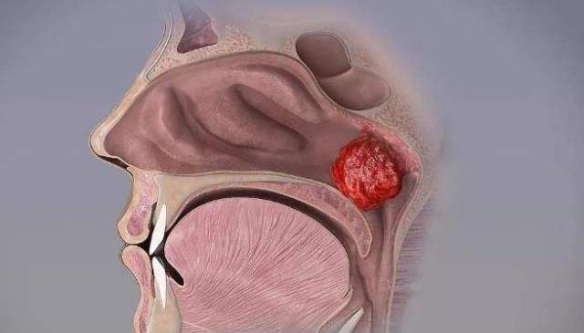 家长出现疑似症状后应注意什么,这种病进入高发期家长该怎么办