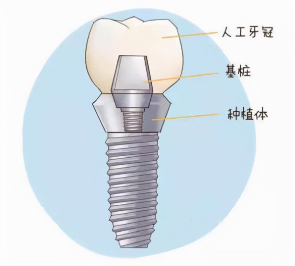 种植牙后对牙齿美学的改变,种植牙齿最后一步需要注意什么