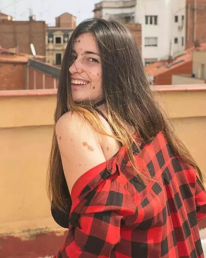 全身黑斑被骂“斑点狗”，身高160的她却成为最美超模…