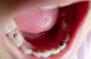 一口黄牙能洗白吗,一口黄牙毁了一张脸