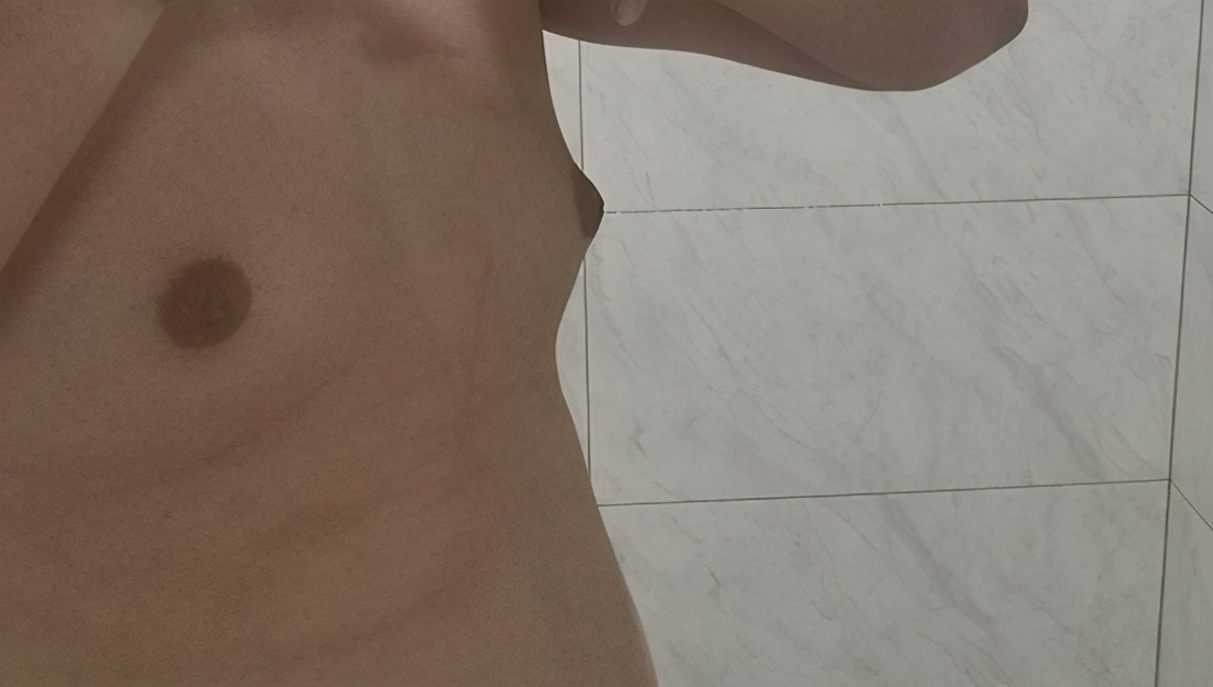 甲亢引起乳房下垂,男性甲亢会引起乳房胀痛吗